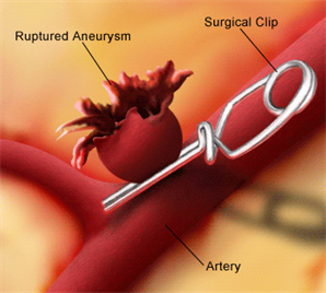 Aneurysm