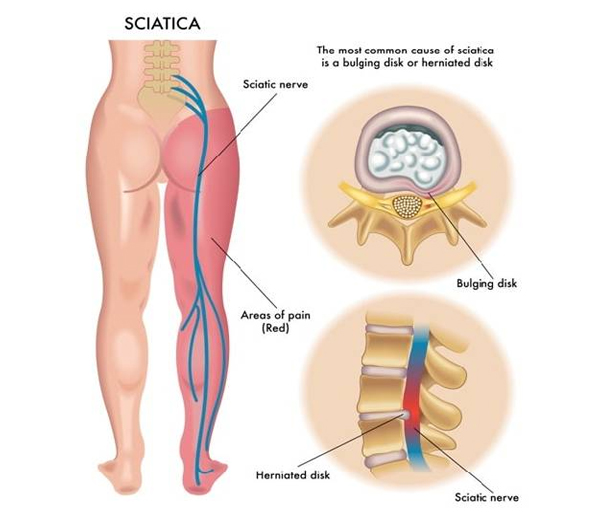 Sciatica
