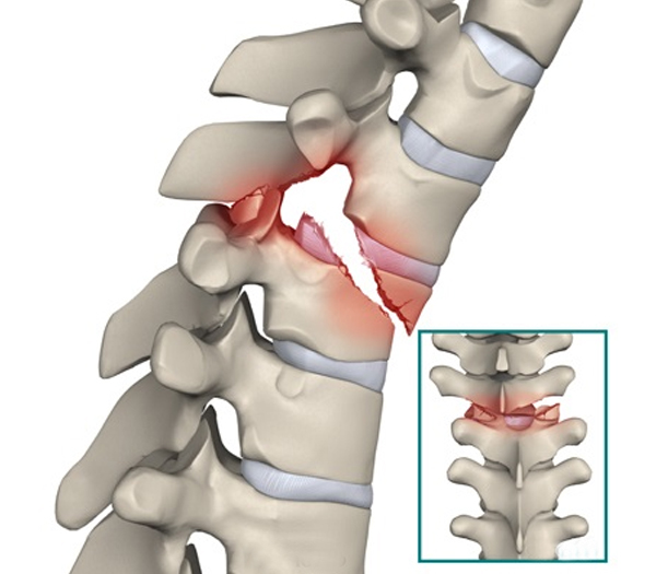 Spinal Fracture