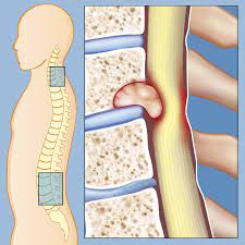Spine Tumor